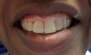 A patient's smile after dental bonding