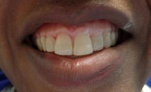 A patient's smile after dental bonding