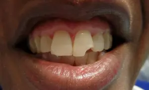 A patient's smile with a chip in their teeth before dental bonding