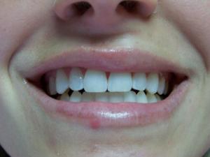 A patient's smile after dental bonding
