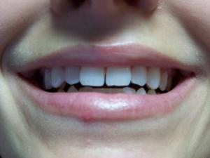 A patient's smile with a gap in their teeth before dental bonding