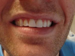 A patient's smile after dental bonding