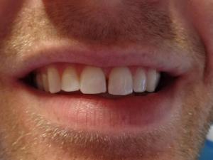 A patient's smile with a gap in their teeth before dental bonding