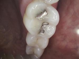 A patient's tooth with metal fillings