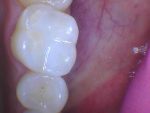 A patient's tooth with tooth-colored fillings