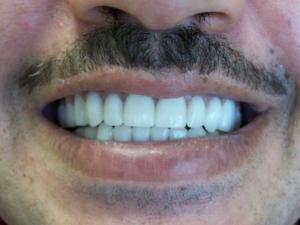 A patient's smile after dentures