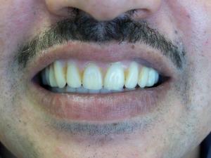 A patient's smile before dentures