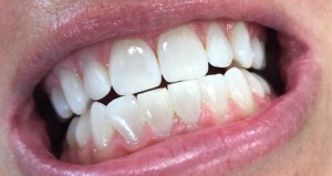 A patient's teeth after Glo Whitening