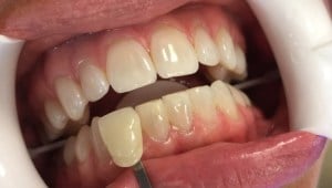 A patient's yellow teeth before Glo Whitening