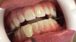 A patient's yellow teeth before Glo Whitening