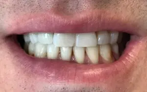 Patient with a dental implant replacing a missing front tooth
