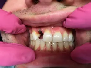 Patient with a front tooth missing