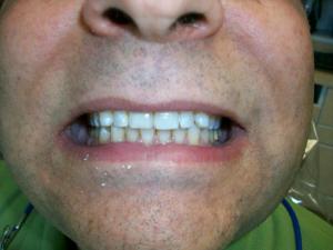 Patient with a dental implant replacing a missing front tooth