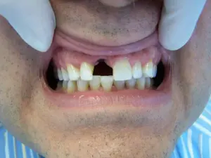 Patient with a front tooth missing