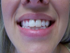 A patient's teeth after internal bleaching