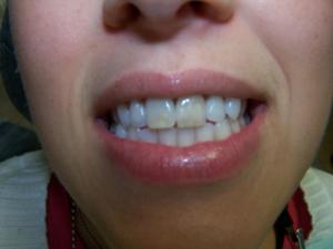 A patient's yellow teeth before internal bleaching