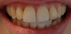 A patient's smile after Invisalign