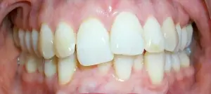 A patient's smile before Invisalign