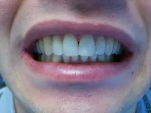 A patient's smile after Invisalign