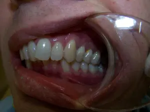 A patient's smile before Invisalign