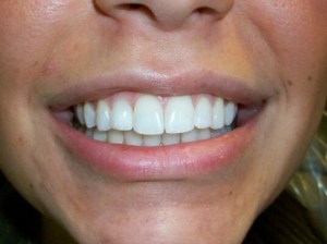 A patient's smile after Invisalign