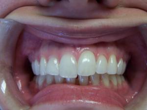 A patient's smile before Invisalign