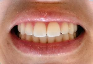 Teeth After