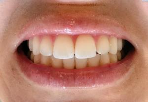 Teeth After