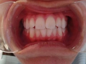 A patient's smile before Invisalign