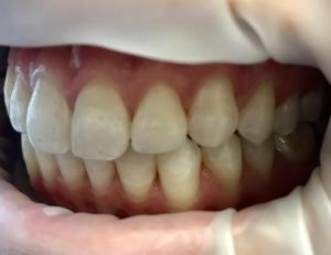 Teeth After