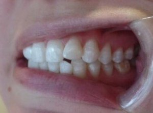 A patient's smile before Invisalign