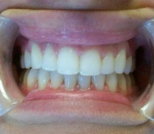A patient's smile after Invisalign