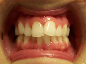 A patient's smile before Invisalign