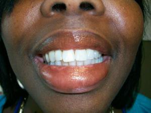 A patient's smile after partial dentures