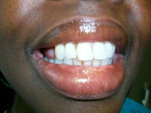 A patient's smile before partial dentures
