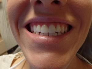 A patient's smile after porcelain veneers