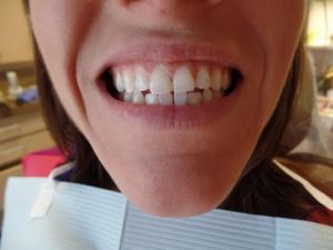 A patient's smile before porcelain veneers