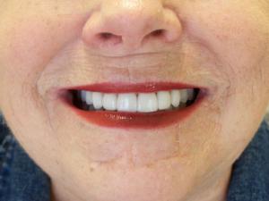 A patient's pearly white teeth after porcelain veneers