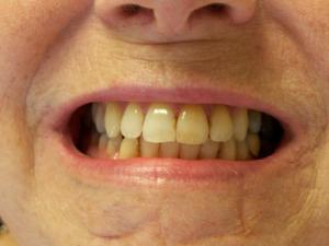 A patient with yellow teeth