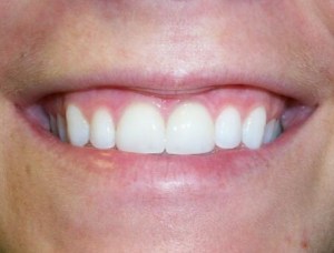 A patient's teeth after porcelain veneers