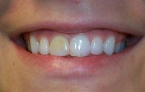 A patient's teeth with one very yellow tooth