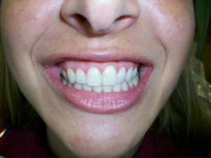 A patient's teeth after white spot treatment