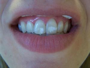 A patient's spotty teeth before white spot treatment