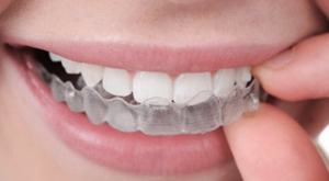 A woman with clear braces in her mouth