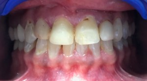A patient's smile before porcelain crowns