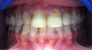 A patient's smile before porcelain crowns