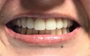 A patient's smile after porcelain crowns