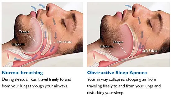 Diagram of normal breathing compared to obstructive sleep apnea