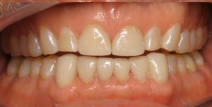 After image of corrected jaw alignment and repaired teeth