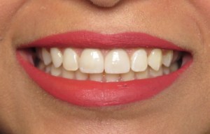 After image of restored straight and white smile